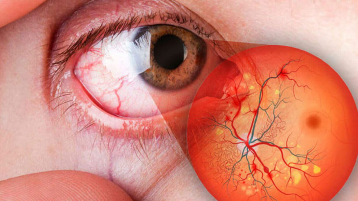 La diabetes, una enfermedad que puede acabar con la visión