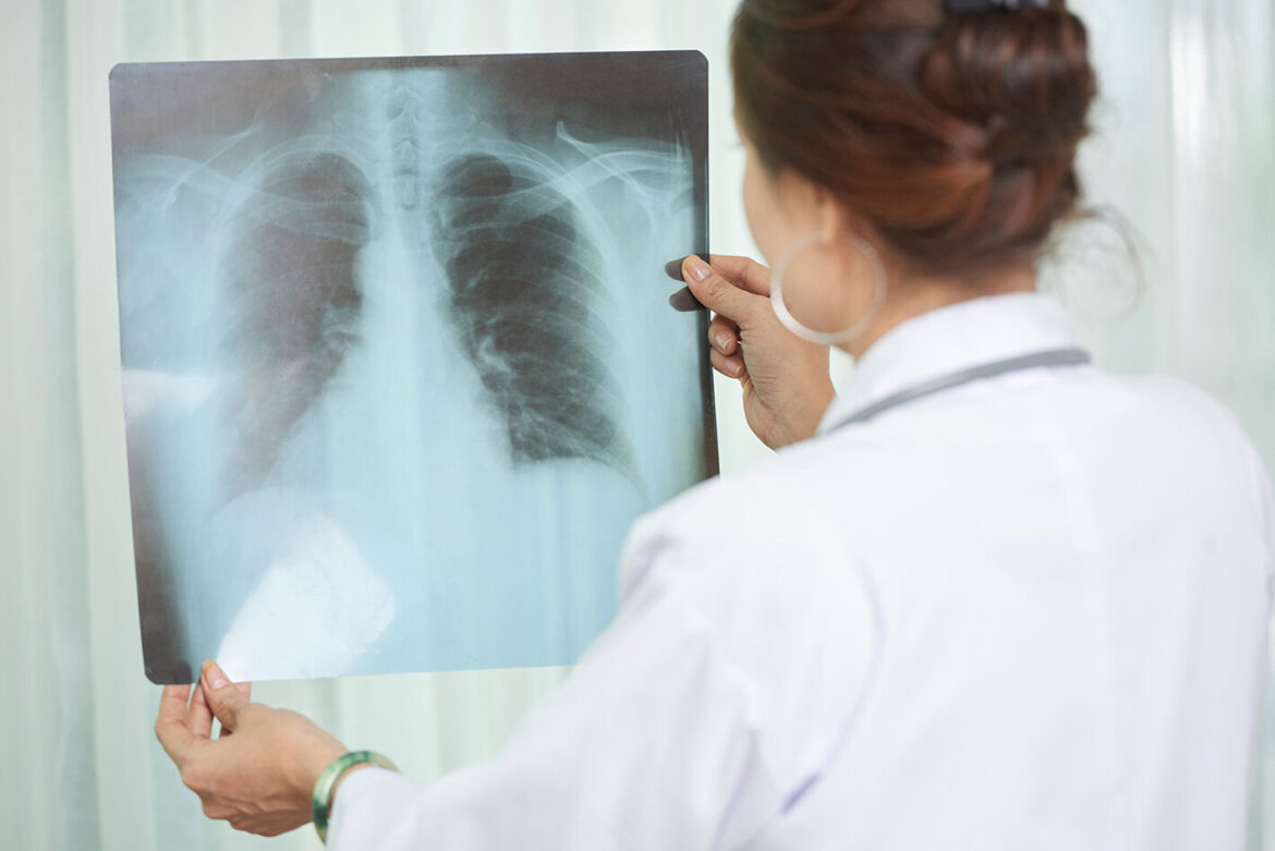 Avances y desafíos en la lucha contra la tuberculosis en RD